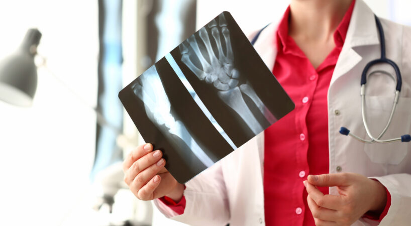 Woman Doctor Holding Right Hand Bone X-ray Image